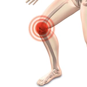 osteoarthritis arthrocalman pain